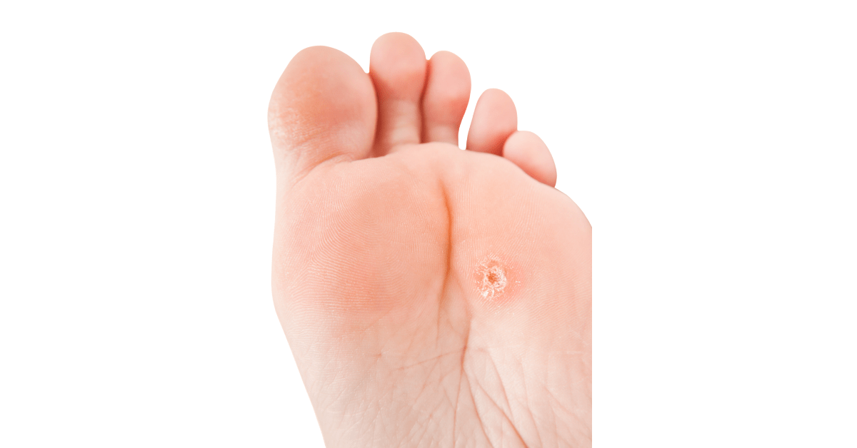 Eliminar, tratar y prevenir los callos