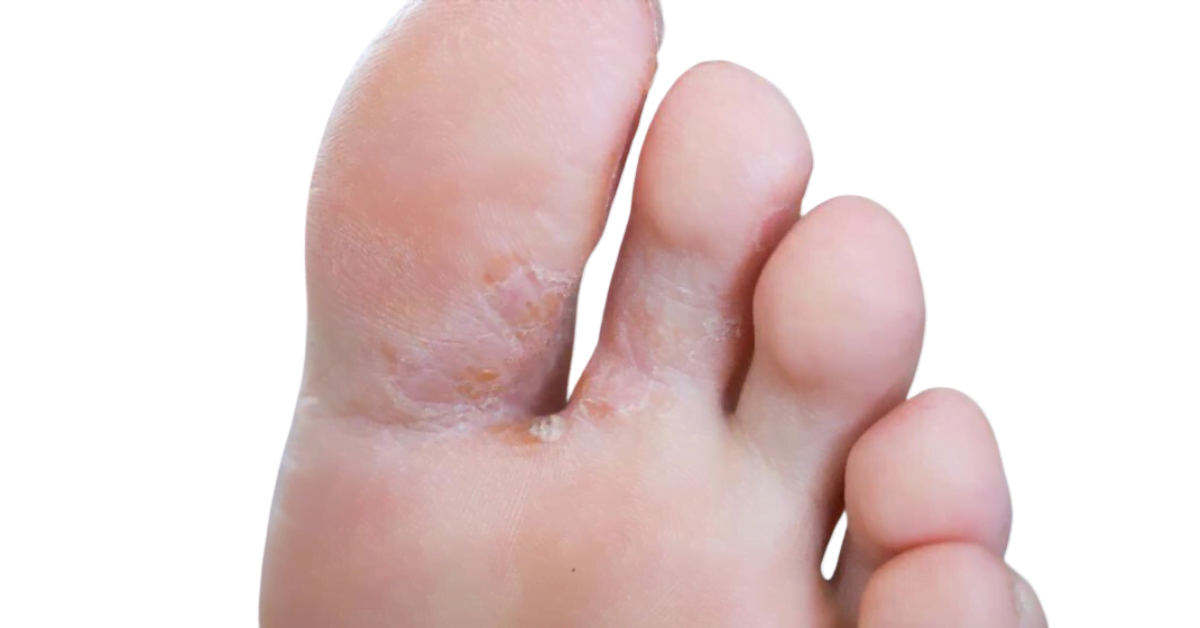 Fußpilz (Tinea Pedis): Symptome und Behandlung